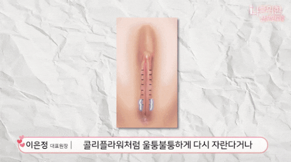 소음순 재발 양상을 도해와 함께 설명하는 영상 장면