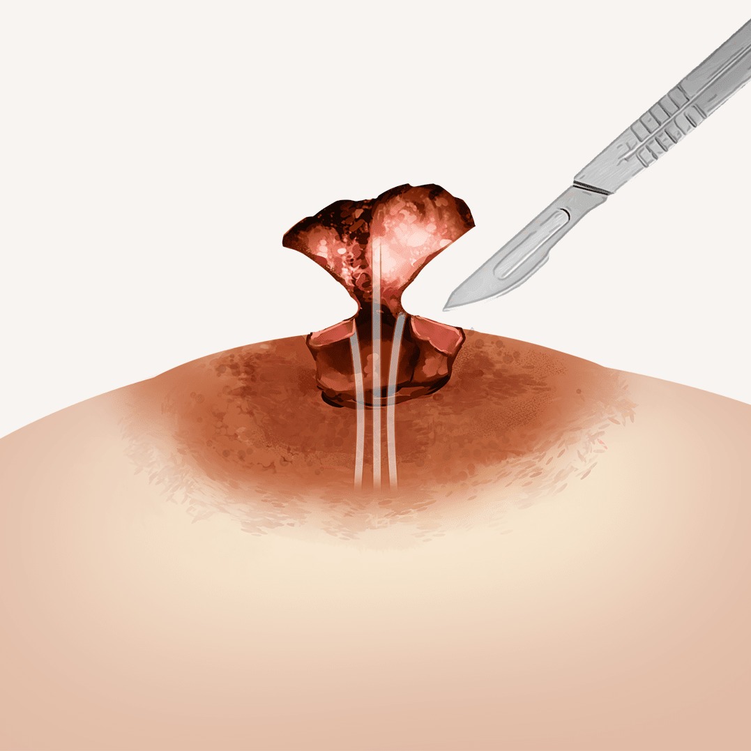 함몰유두 교정 수술 과정 도해 — 나를위한산부인과 안내 자료