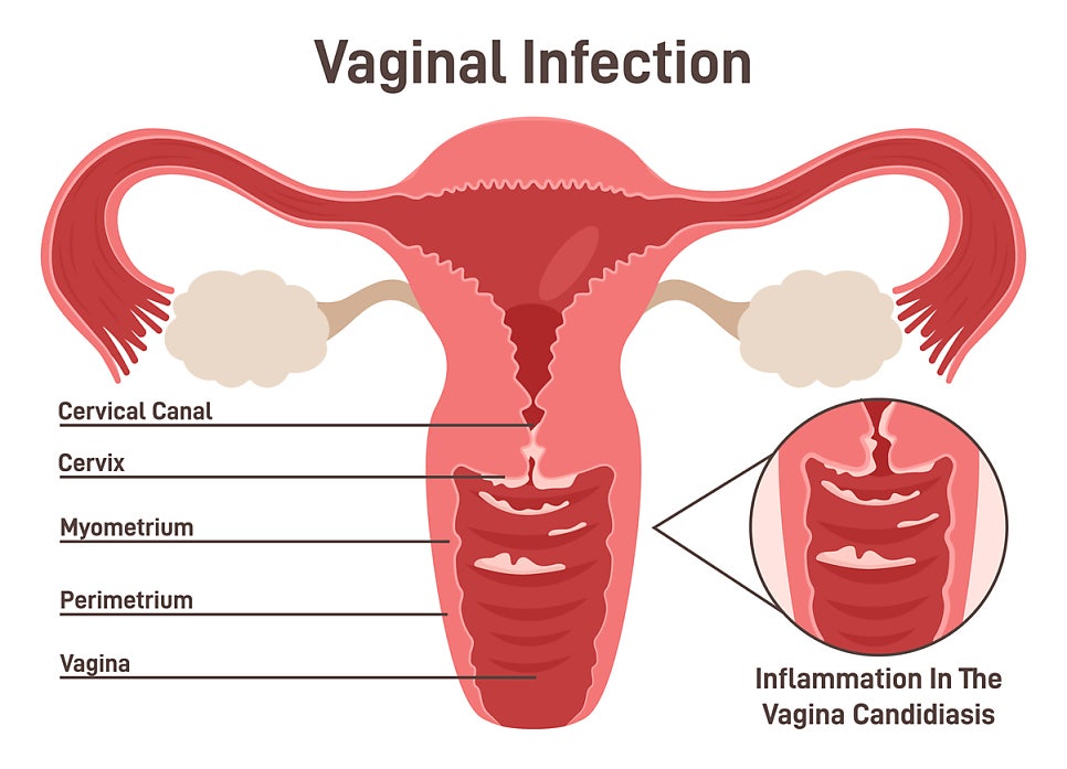 "Vaginal Infection" 제목의 영문 의학 일러스트