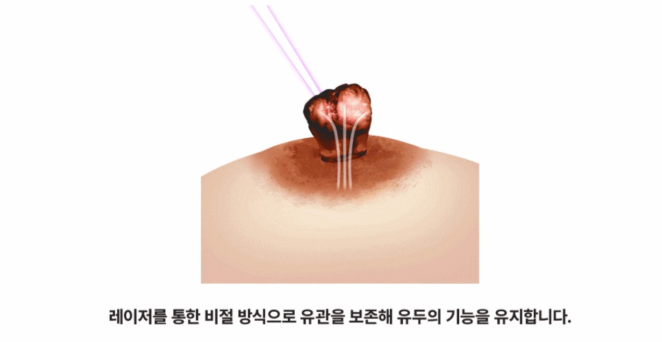유두미백5