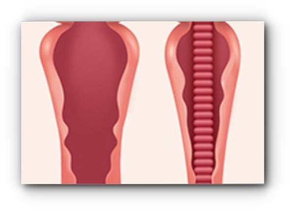 소음순수술4