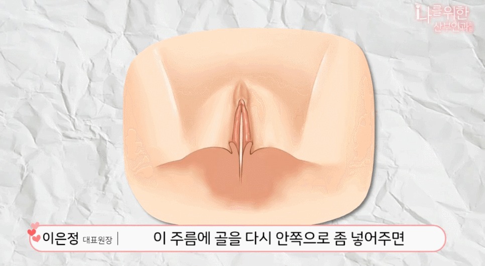 소음순수술7