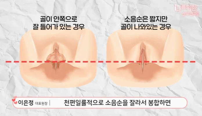 소음순수술5