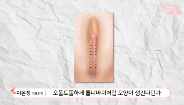 소음순수술7