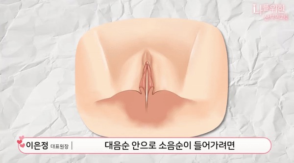 소음순수술9