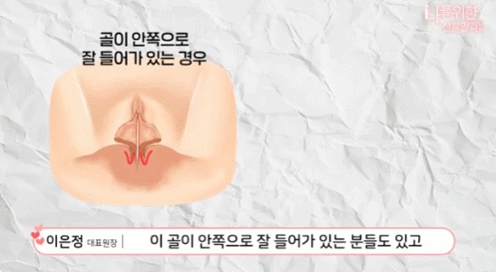 소음순수술3