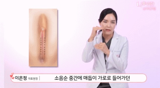 소음순수술5