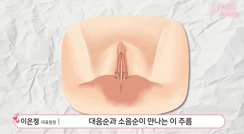 소음순수술8