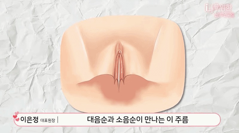 소음순수술8